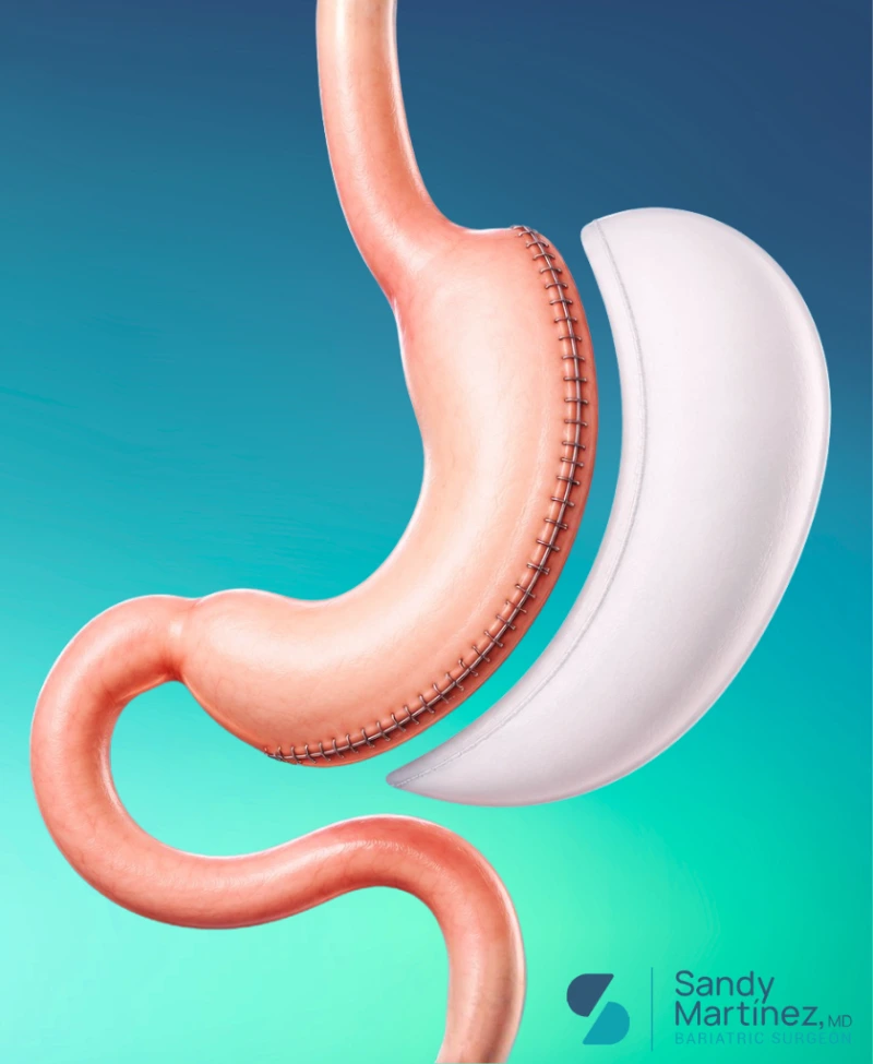 Gastric Sleeve Surgery in Mexico (VSG)