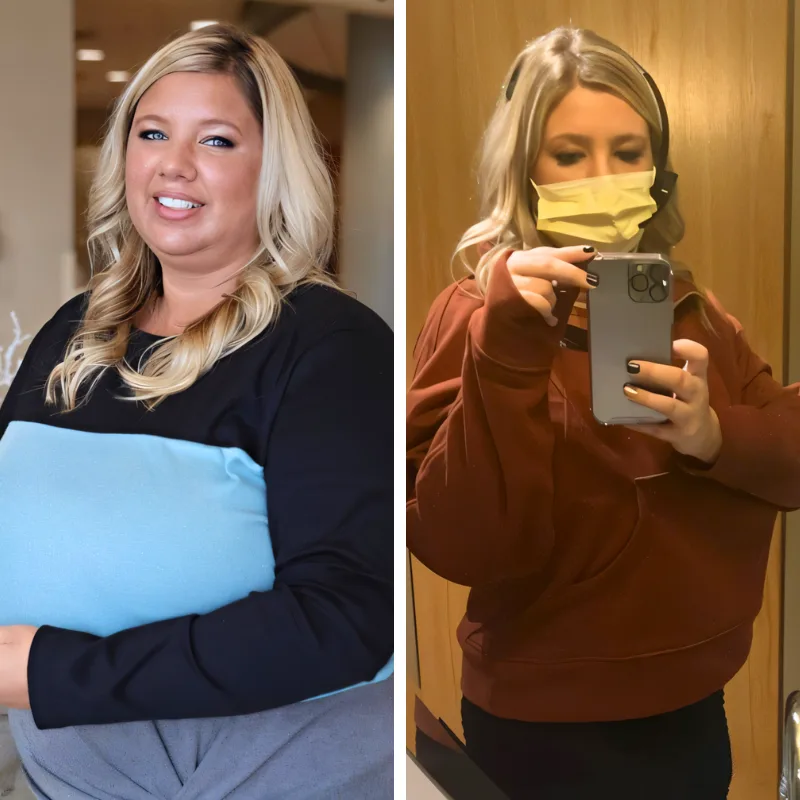 Gastric Sleeve in Tijuana - Before and After Picture