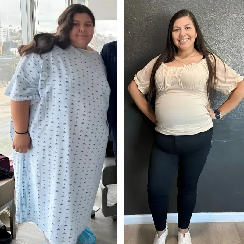 Gastric Sleeve in Tijuana Mexico - Before and After Photo