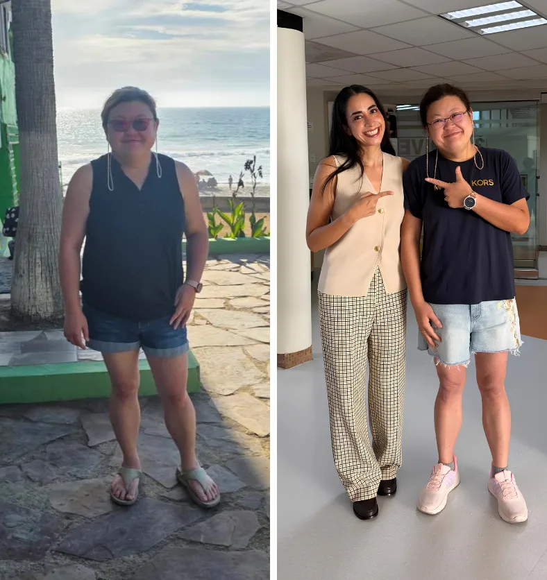 Monalisa with Dr. Sandy Martinez - Before and After Photo