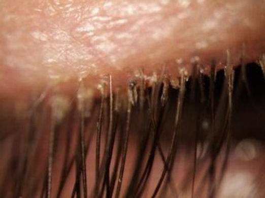 Blepharitis signs and symptoms