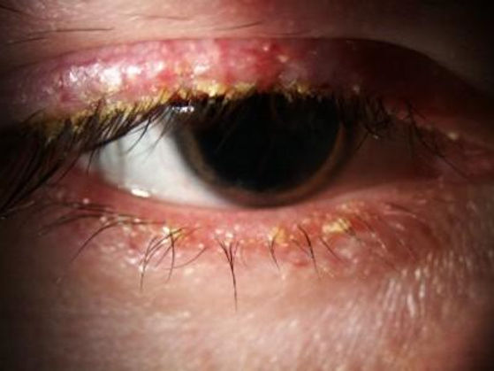 Chronic Blepharitis signs and symptoms