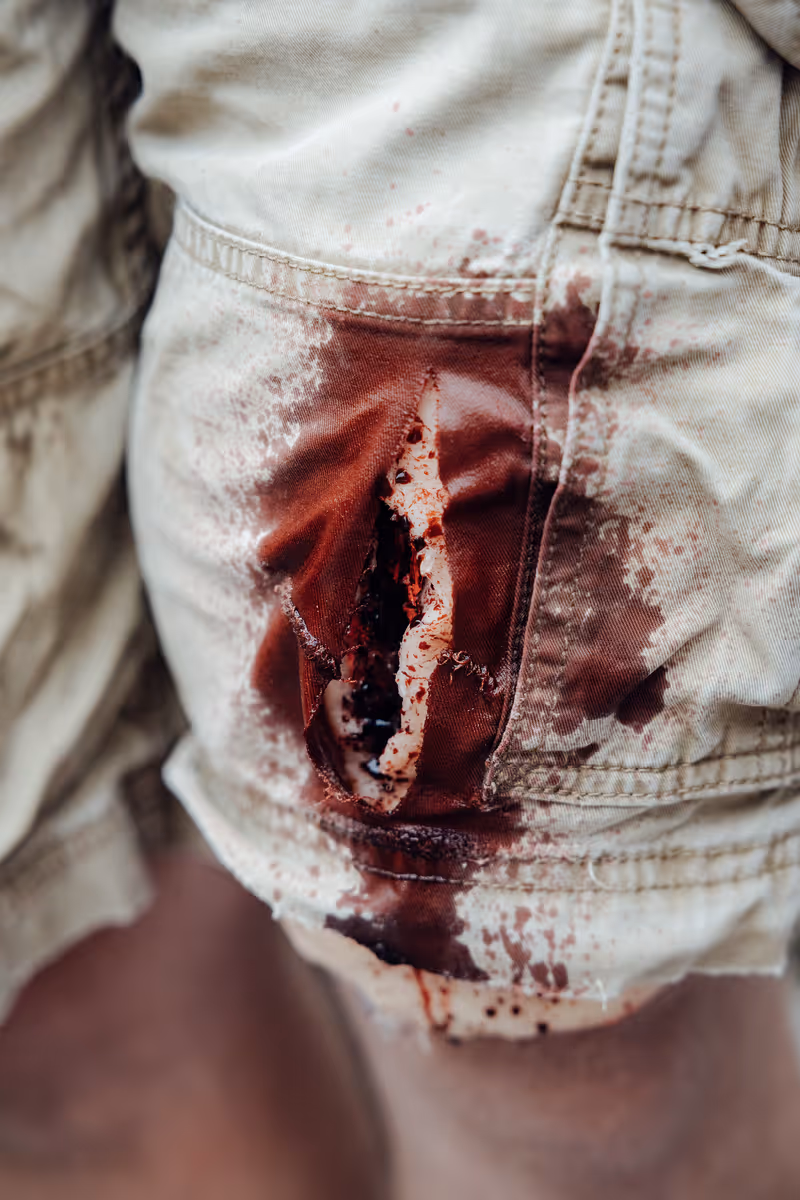 Nahaufnahme einer blutbefleckten, zerrissenen Hose am Oberschenkel.