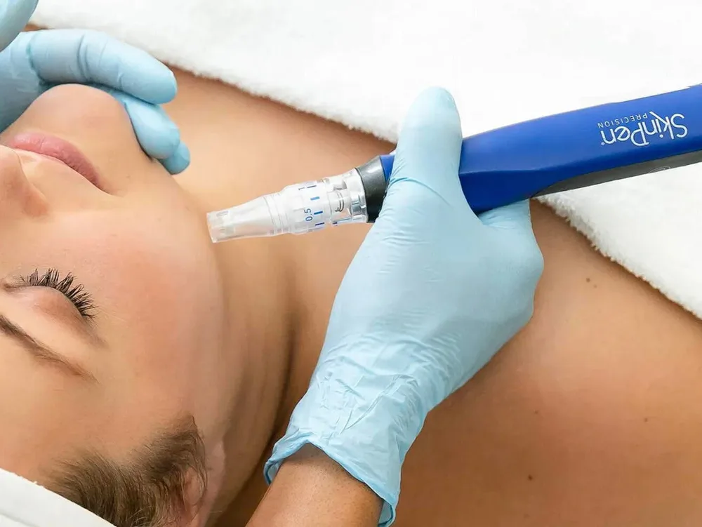 SkinPen microneedling treatment on a client's cheek