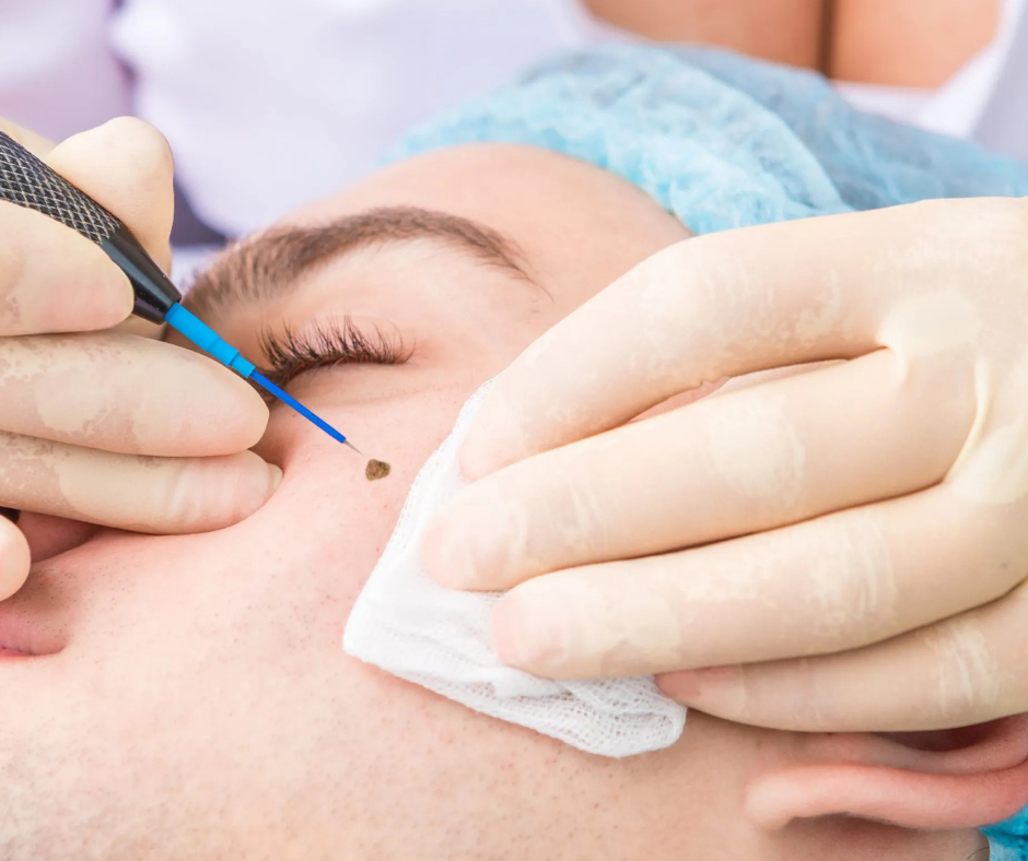 Lamprobe skin tag and milia removal at Elite Skin and Body MD Spring TX