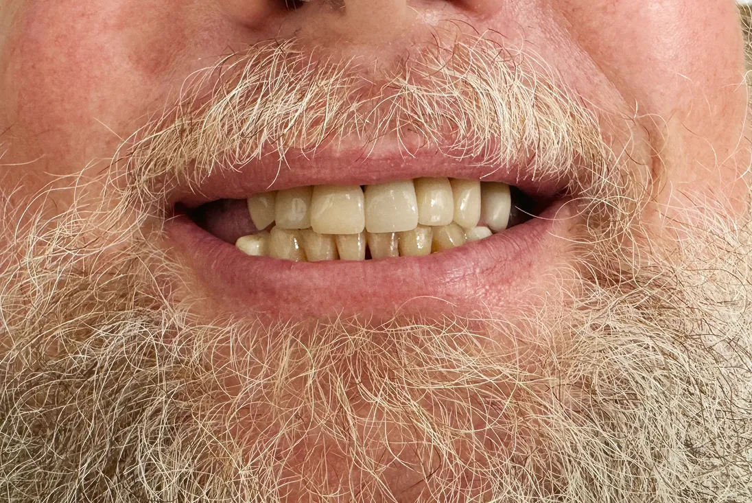 Close-up of a man's mouth with a mustache, beard, and partially visible teeth including dental crowns.