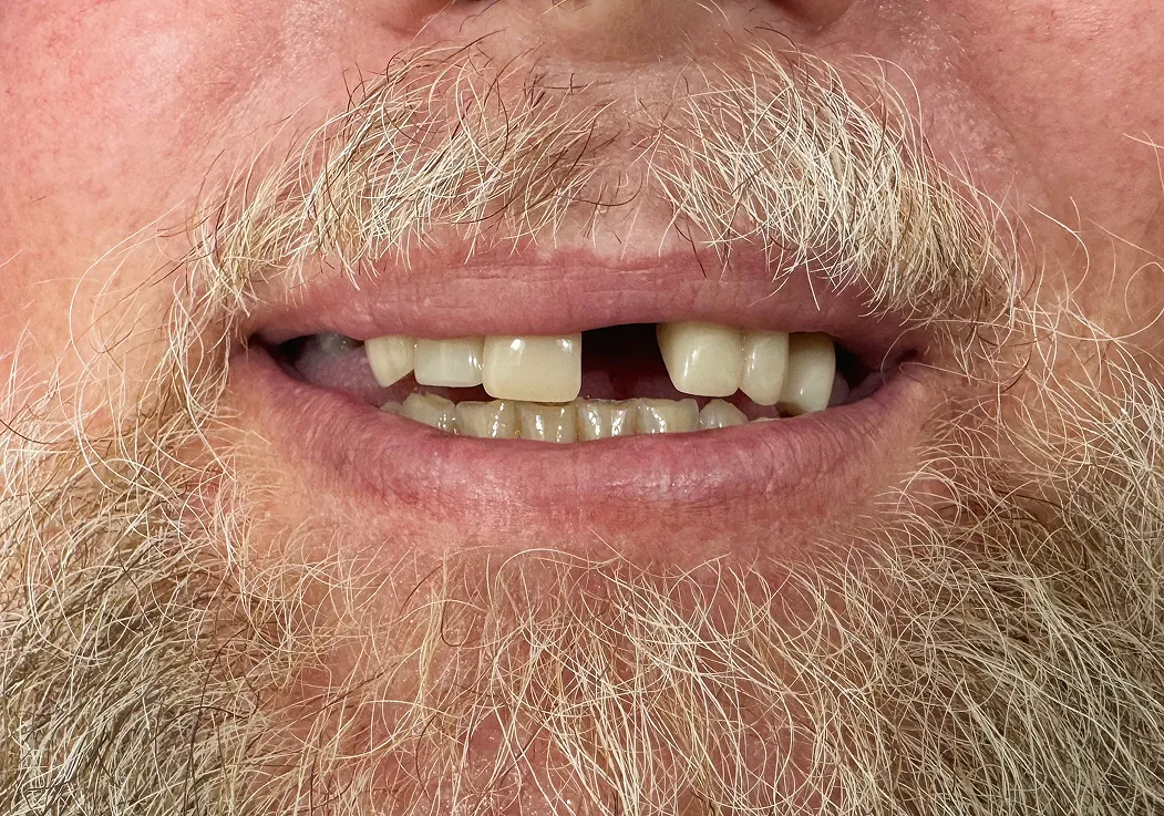 Close-up of a man's lower face with a mustache, beard, and a missing upper front tooth.