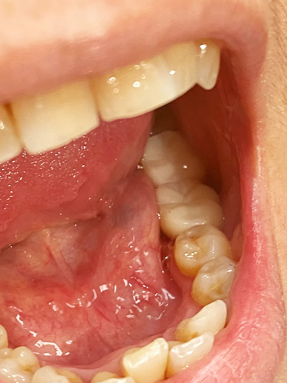 Close-up of open mouth showing tongue, gums, and teeth including molars and a canine tooth.