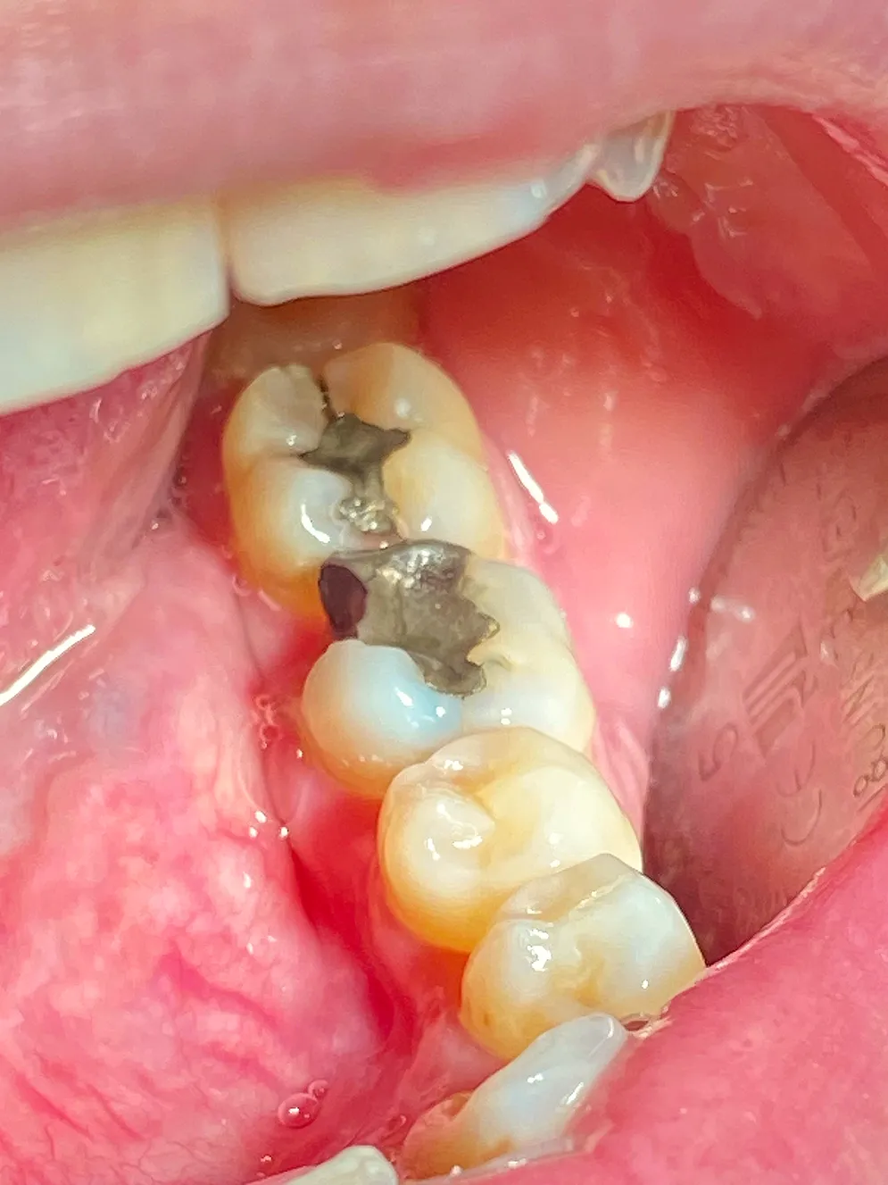 Close-up of molars with a broken silver dental filling in the back tooth inside a mouth.