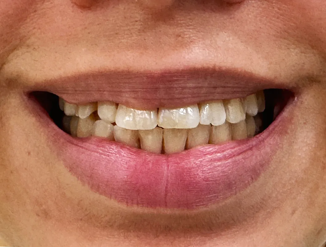 Close-up of a smile showing uneven, discolored upper front teeth and slightly stained lower teeth.