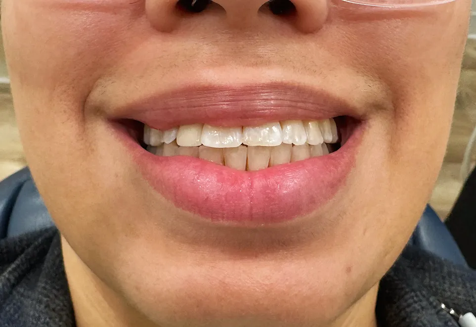 Close-up of a smile showing upper teeth with dental cosmetic crowns and natural lower teeth.