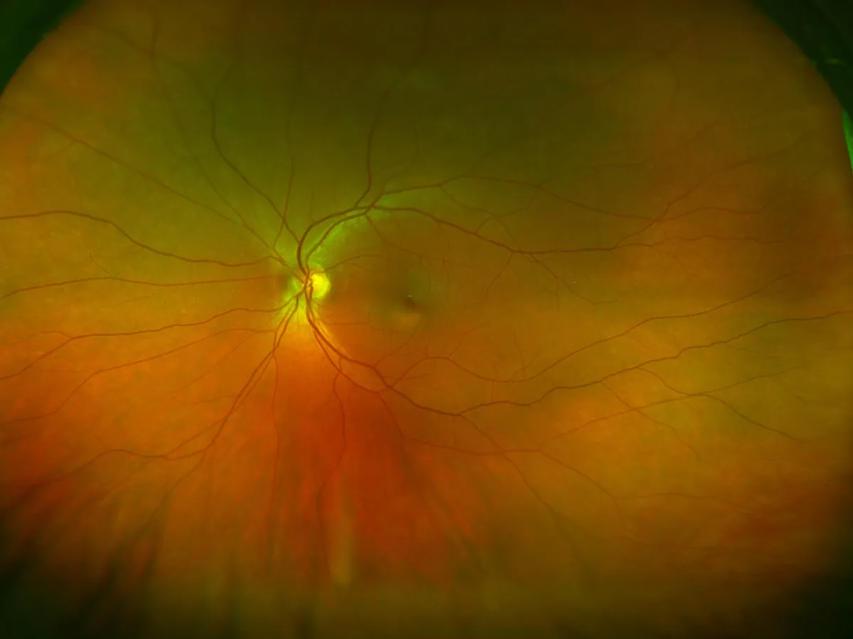 Close-up image of a human retina showing the optic disc and branching blood vessels.