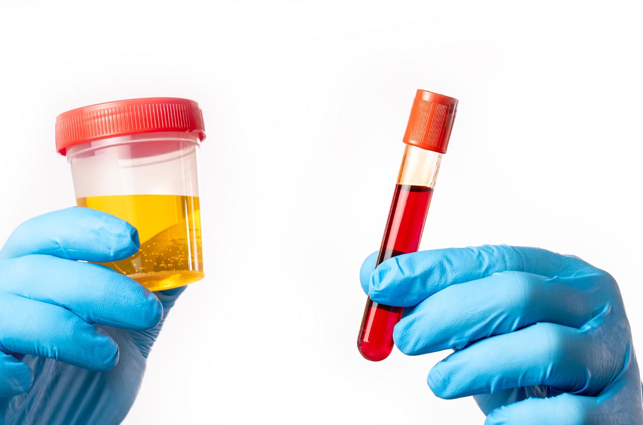 Blood test vs. Urine test