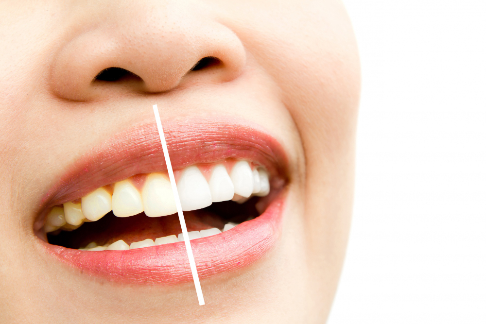 Teeth Whitening in Ridgewood & Greenpoint | Eurodental