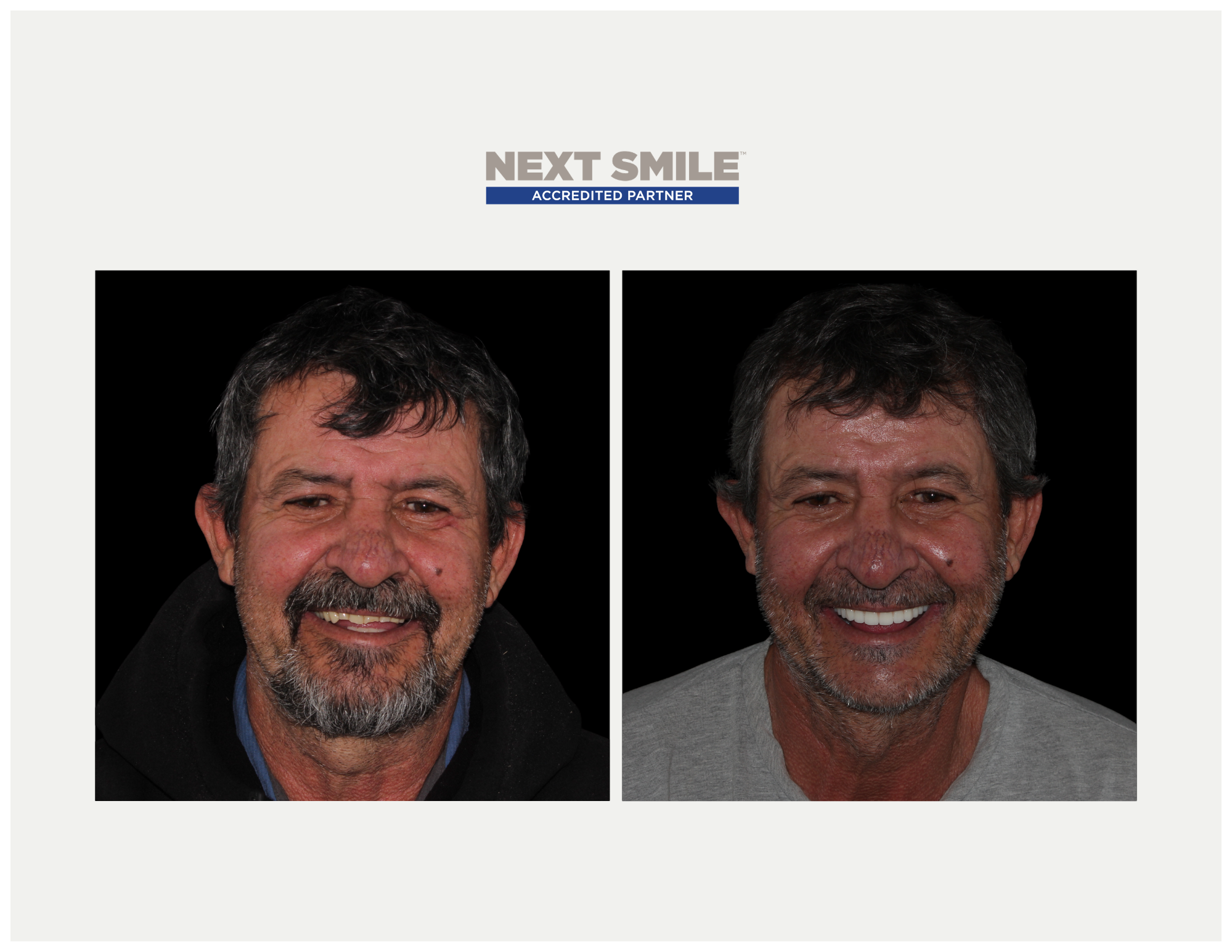 Next Smile patient Neil Lontis