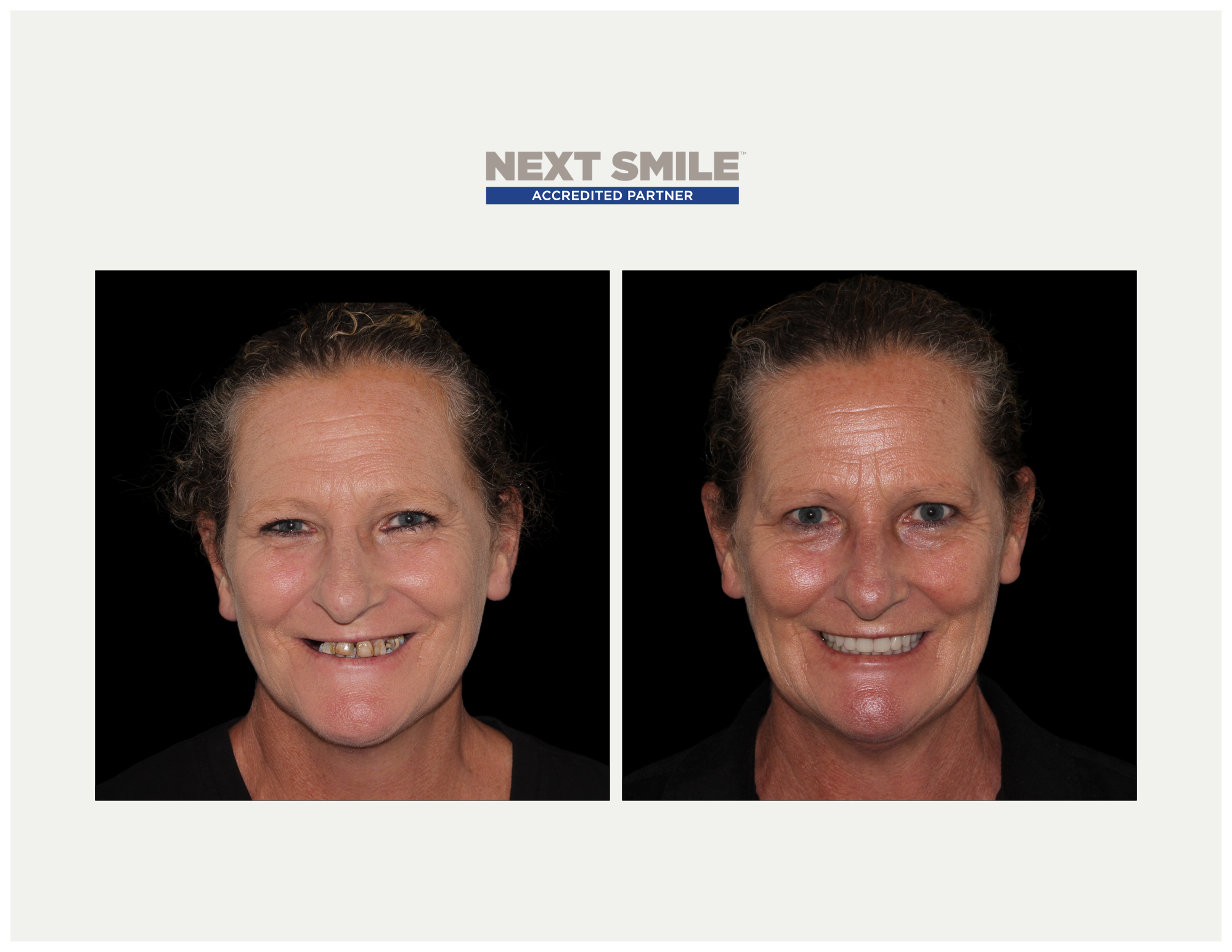 Next Smile patient Meredith Hall