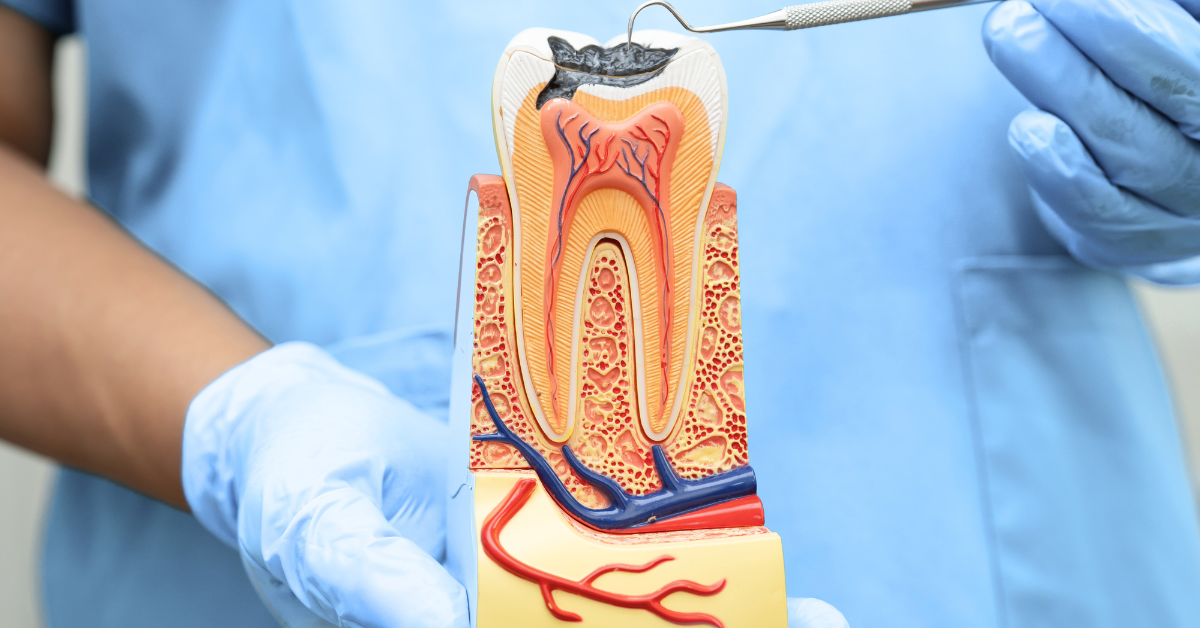 Root Canal Treatment