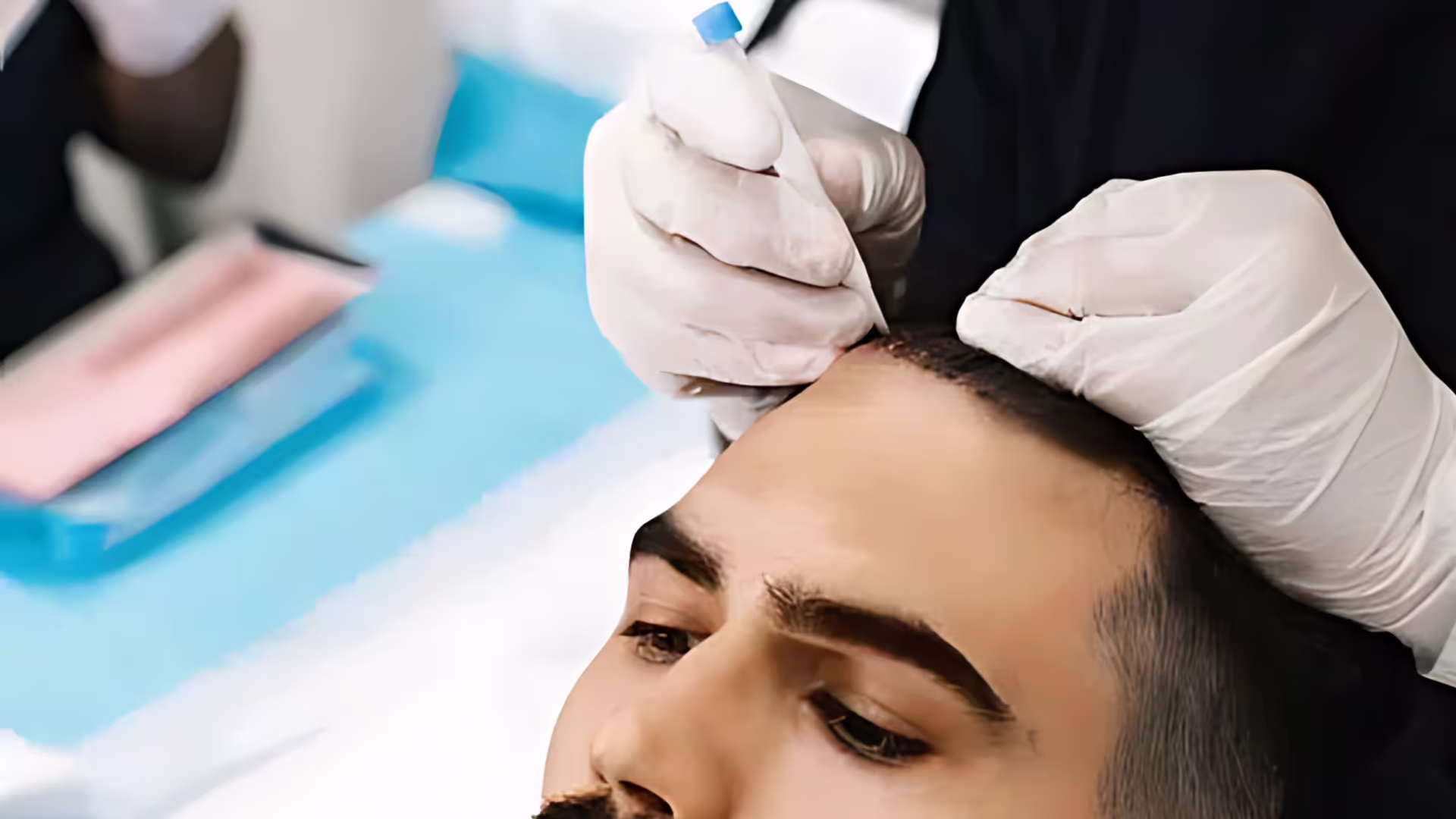Hair Transplant Cyprus Recovery: Timeline, Tips, and What to Expect