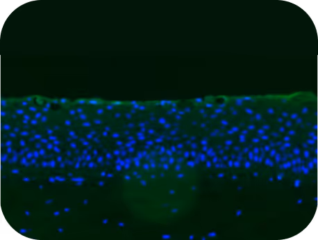 Harlequin ichthyoses 3D skin culture