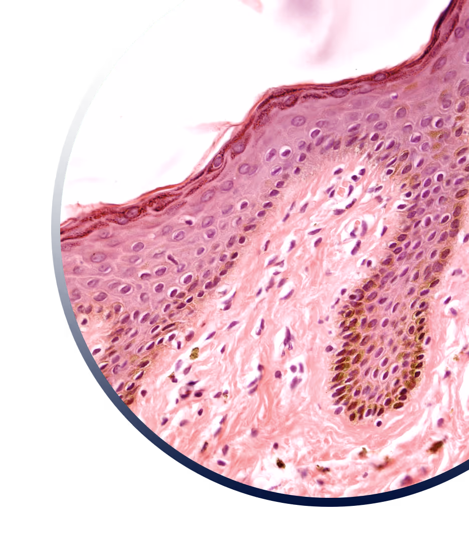 Targeting a shared molecular driver in rare skin diseases:  TRPV3
