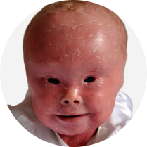 Chronic, early-onset diseases