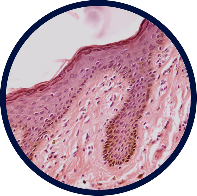 Targeting a Shared Molecular Driver in Rare Skin Diseases: TRPV3