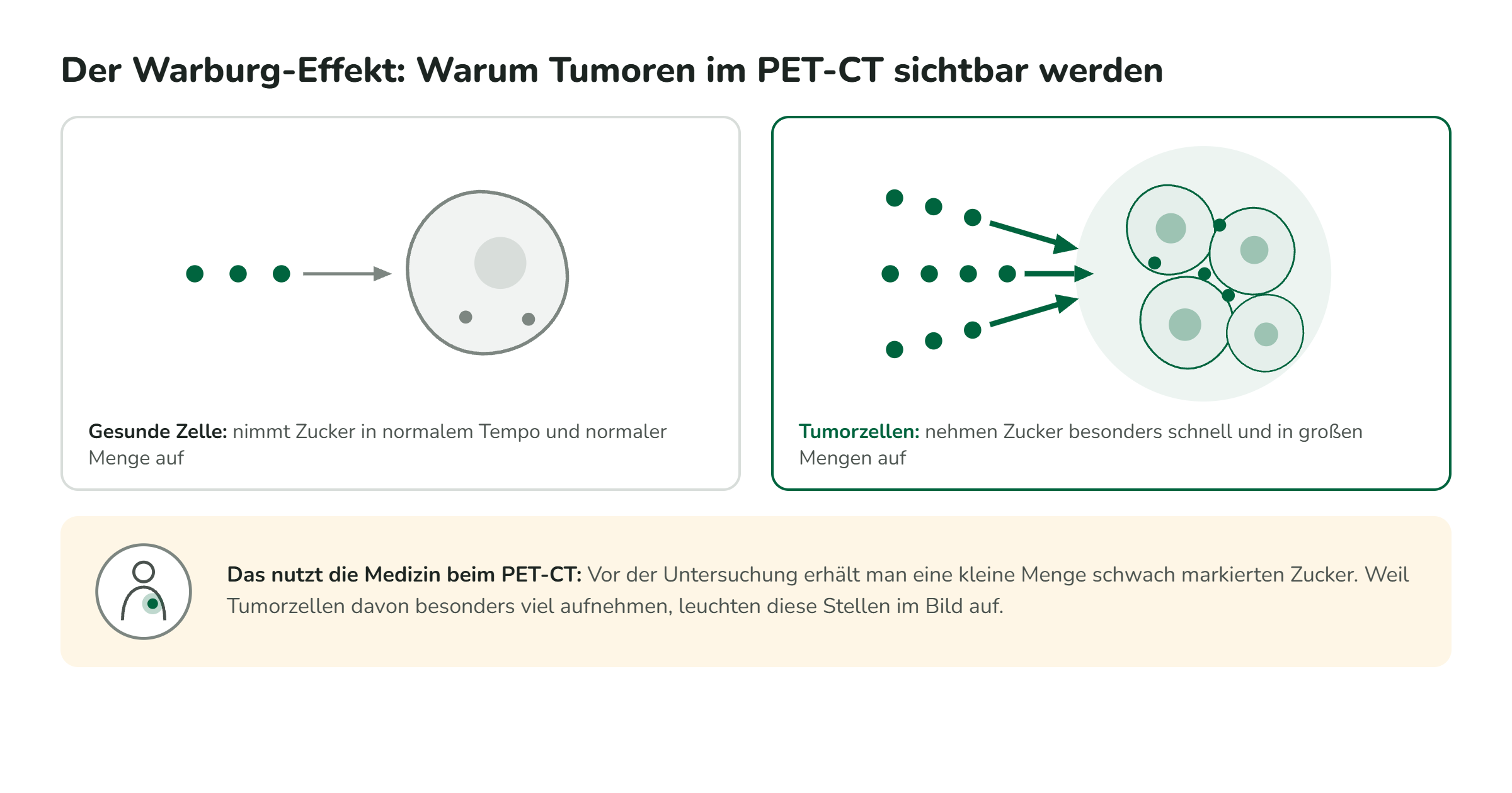 Zwei Zellen nebeneinander, gesunde Zelle und Krebszelle, beide nehmen Glukose auf