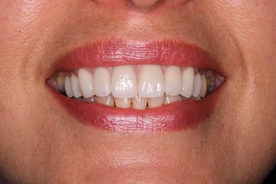 Close-up of a smiling mouth with red lipstick showing clean, white teeth.