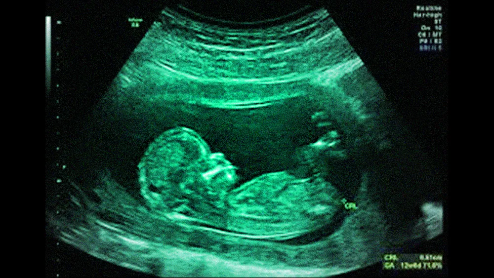 fetal ultrasound image