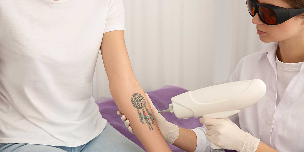 Technician wearing gloves and protective glasses removing colorful tattoo on a person's forearm with a laser device.