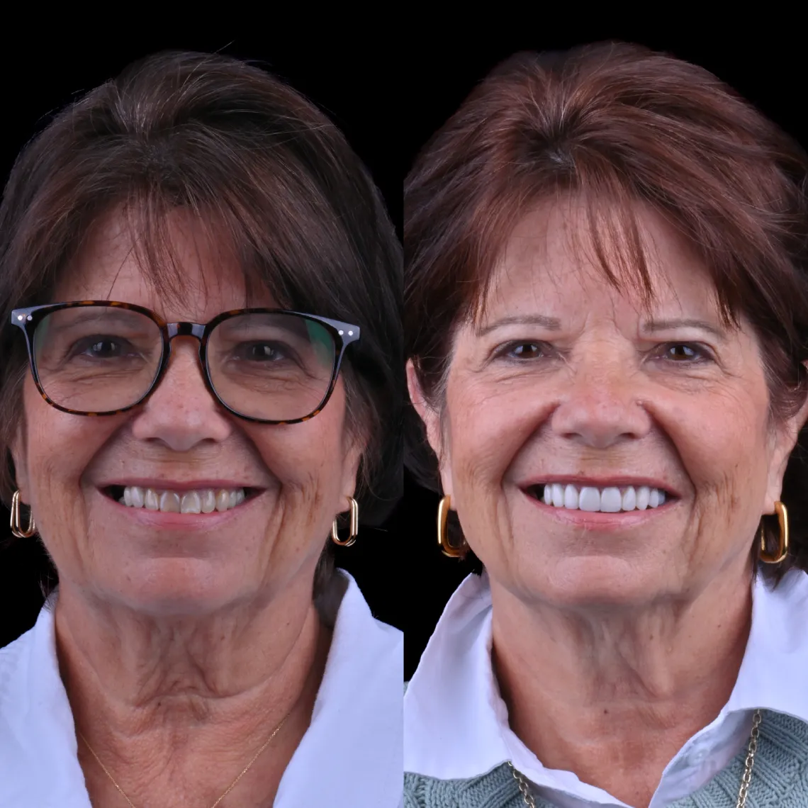 Side-by-side close-up of an older woman smiling; left image with glasses and natural teeth, right image without glasses and with noticeably whiter teeth.