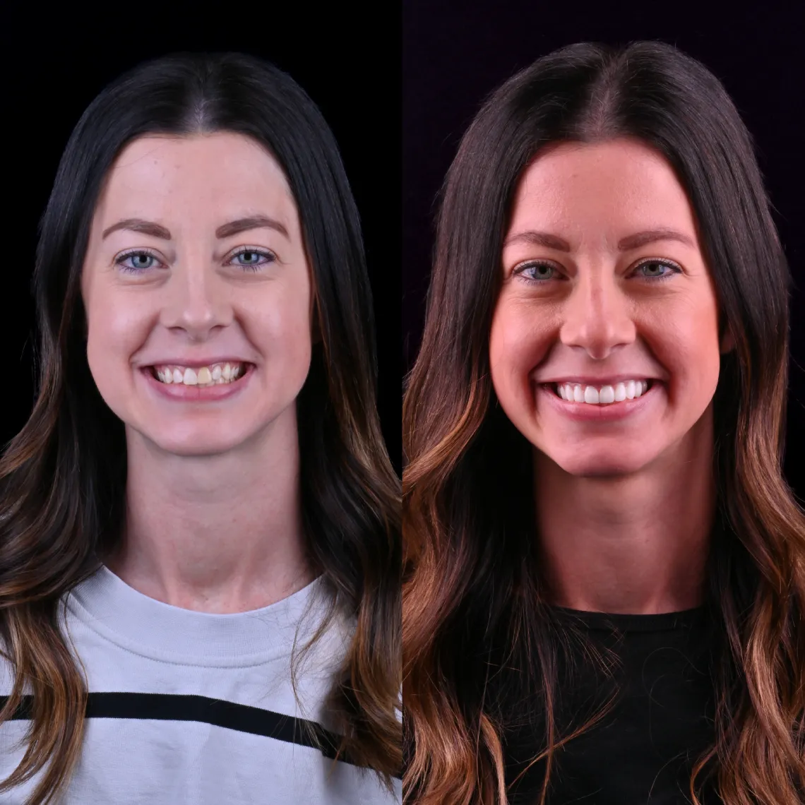 Side-by-side comparison of a woman smiling, showing before and after teeth whitening.