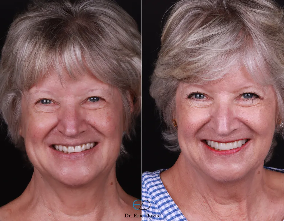 Side-by-side portraits of an older woman before and after a cosmetic dental treatment, showing whiter teeth and slight makeup in the after photo.