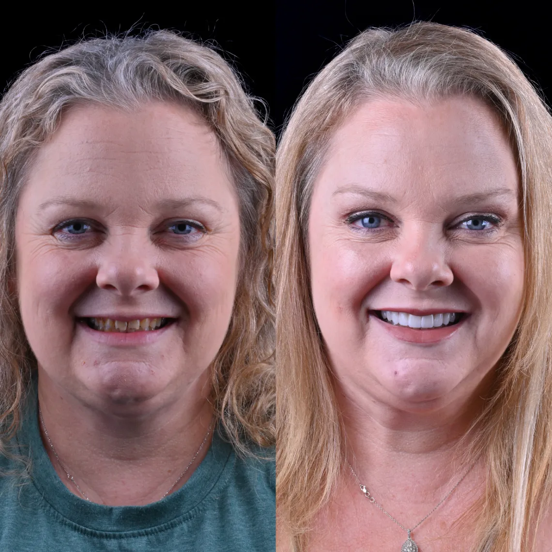 Before and after close-up portraits of a woman smiling, showing teeth improvement and hair styling.