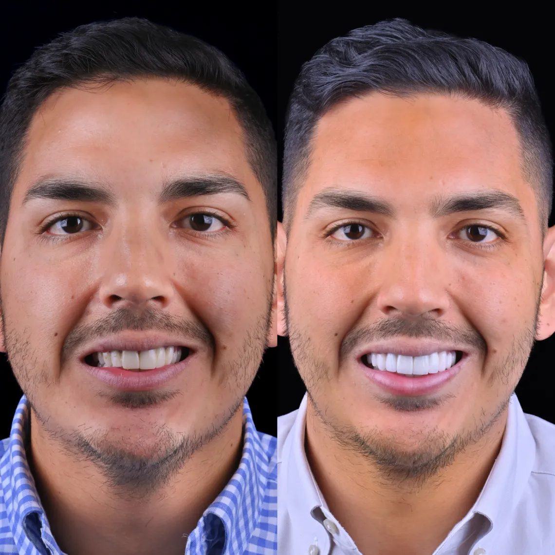 Side-by-side close-up of a man smiling before and after dental treatment, showing whiter, straighter teeth in the after image.