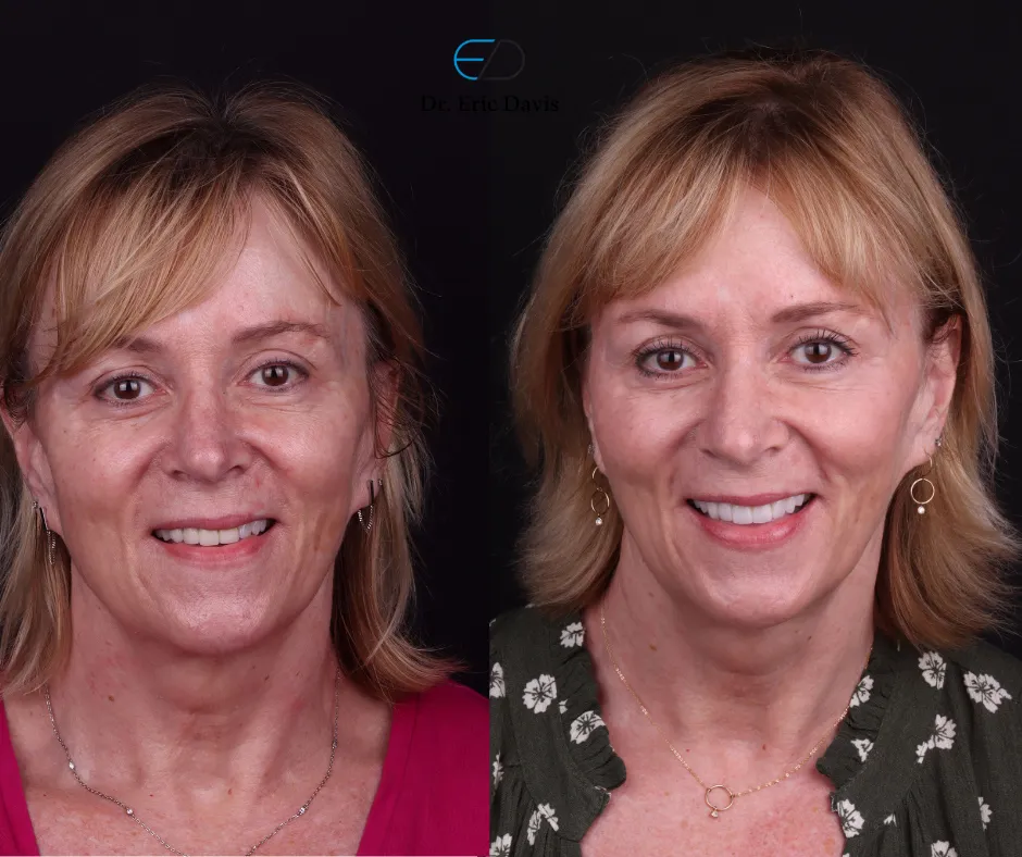 Side-by-side portrait of a middle-aged woman before and after dental treatment showing improved teeth and smile.