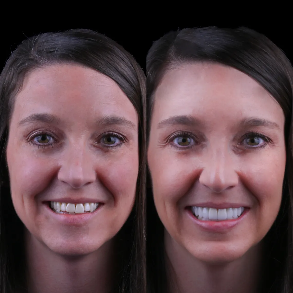 Side-by-side close-up of a woman's face showing before and after teeth whitening results.