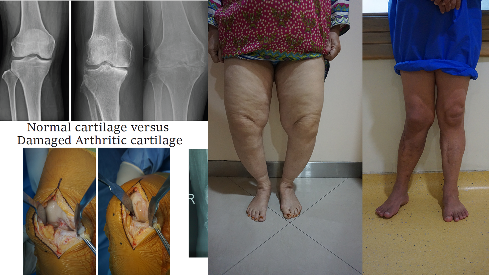 A middle-aged adult easing knee stiffness while standing up, illustrating everyday knee osteoarthritis symptoms.