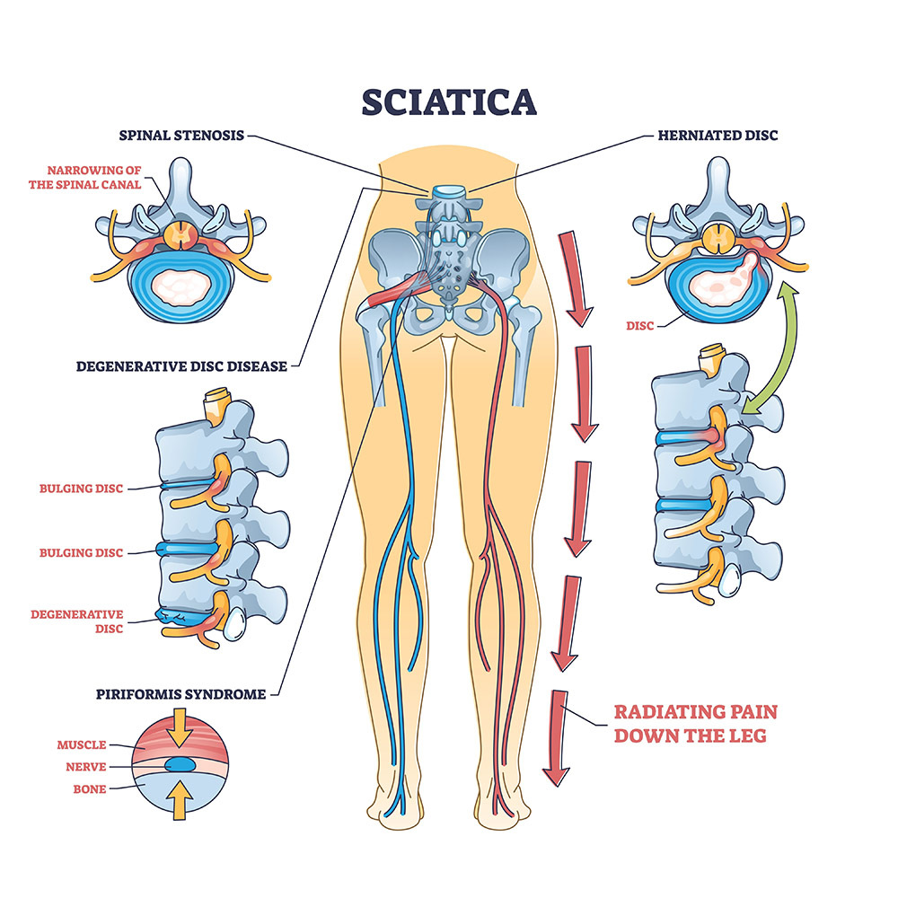 Labelled diagram of the lower spine showing vertebrae, discs, facet joints and a nerve root, with common sources of back pain.