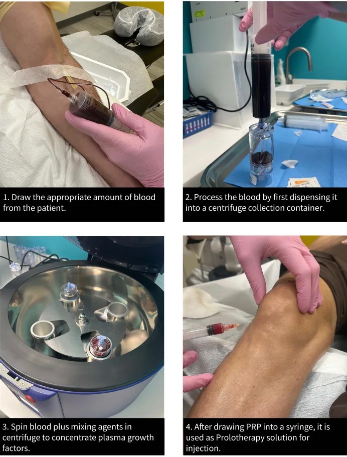 Diagram of the PRP process: blood draw, centrifuge separation into layers, and injection of concentrated platelets into a joint.