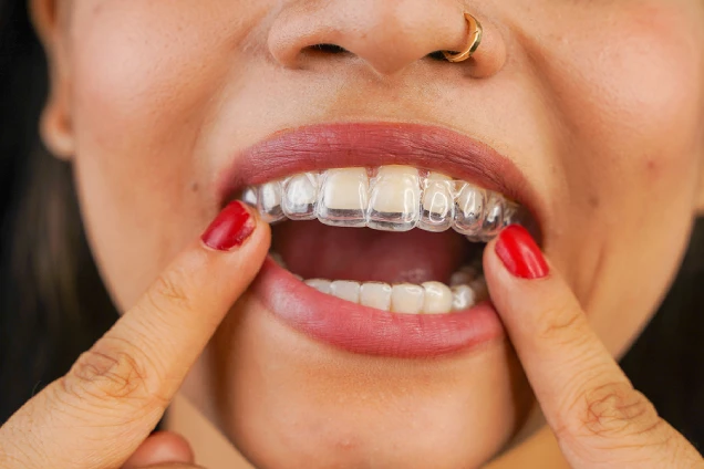 Invisalign - Benefit 1