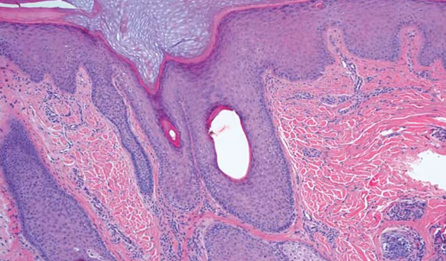 KM-001, a novel TRPV3 inhibitor, demonstrates safety and preliminary efficacy 