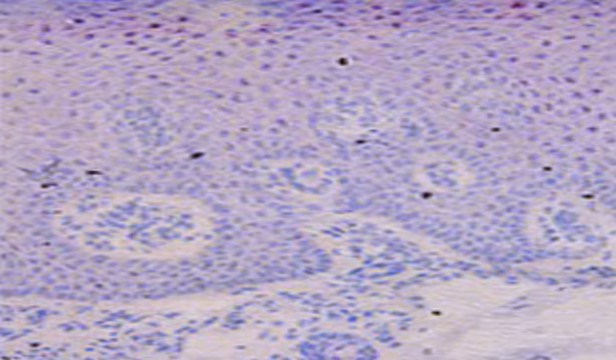 TRPV3 antagonist treatment reduces pro-inflammatory pathways in Olmsted syndrome