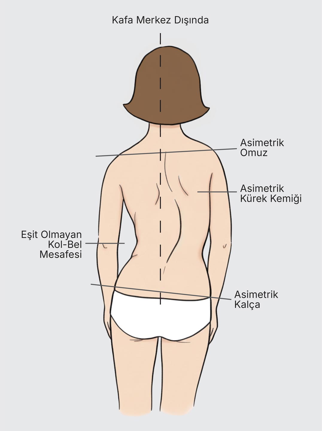 Illustration of a woman’s back showing scoliosis symptoms with asymmetric shoulders, shoulder blades, hips, and uneven arm-to-waist distance.
