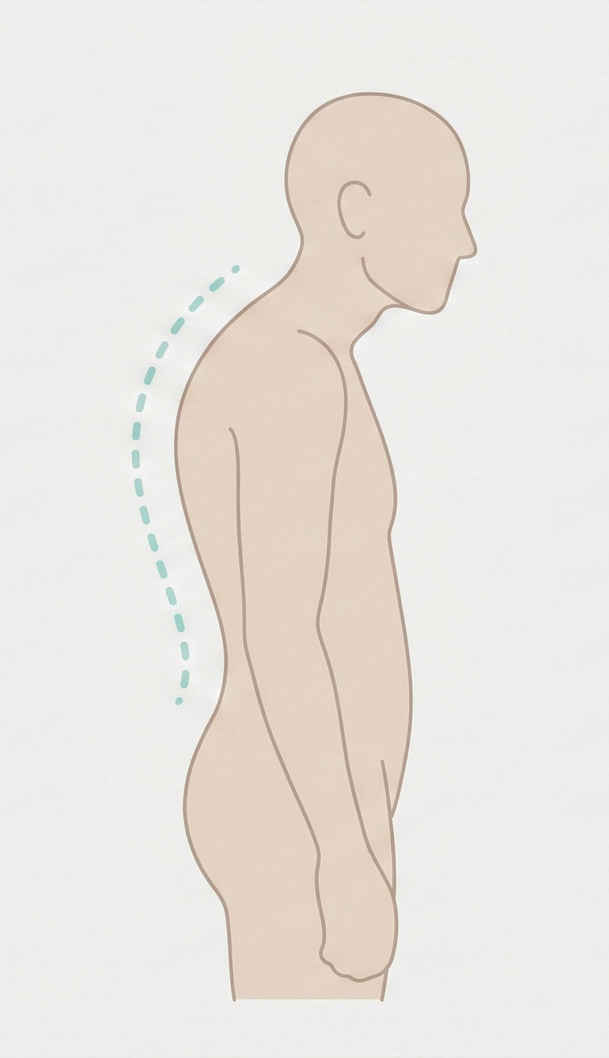 Side view illustration of a person with a curved upper back indicating kyphosis.