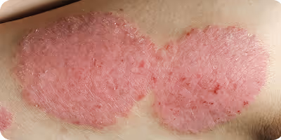 Two red, scaly patches of atopic dermatitis on the skin.