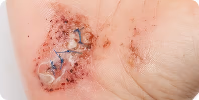 Scar with blue stitches and a transparent drain on the skin.