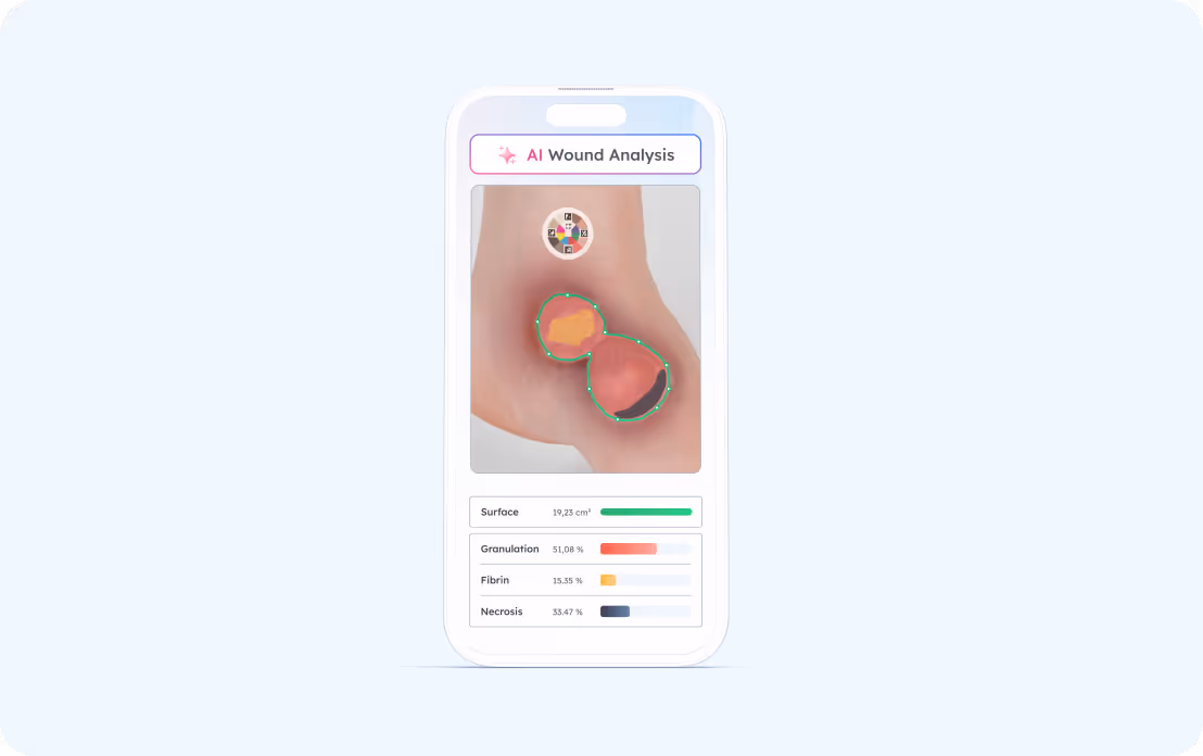 Analyse de plaie IA sur smartphone montrant une plaie au coude avec surface et pourcentage des tissus.
