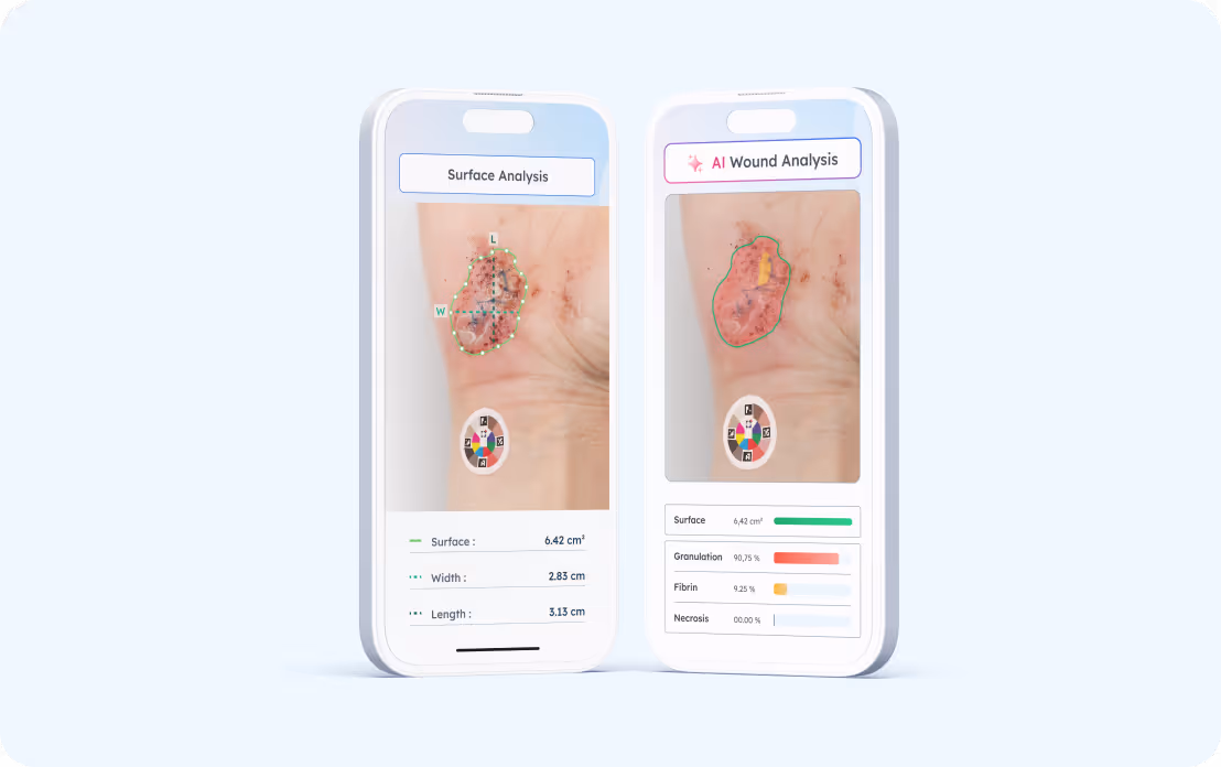Deux téléphones affichant une analyse de plaie sur un poignet avec mesures et analyse IA.