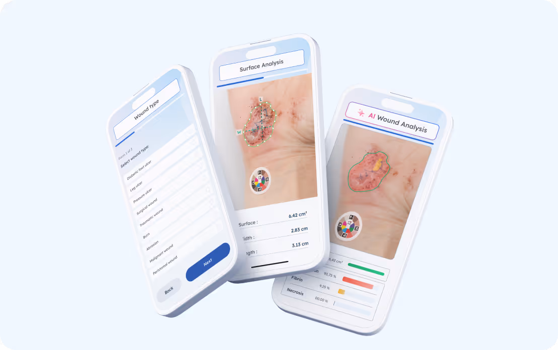 Trois écrans de smartphone affichant une analyse de plaie par IA avec mesures et options de sélection de type de plaie.